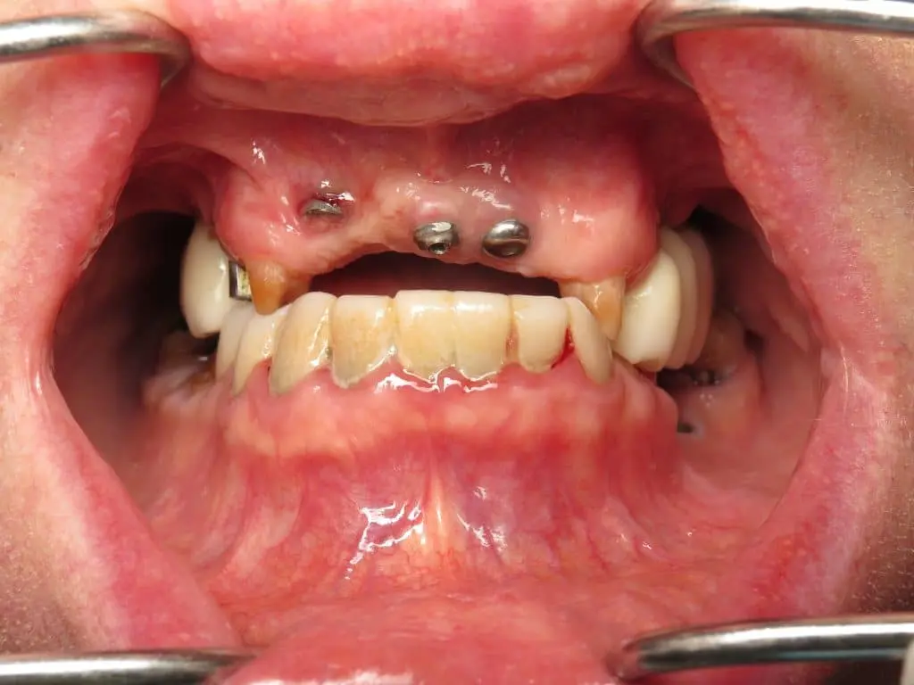i smoked after dental implant surgery - How long does it take for smoking to affect your teeth