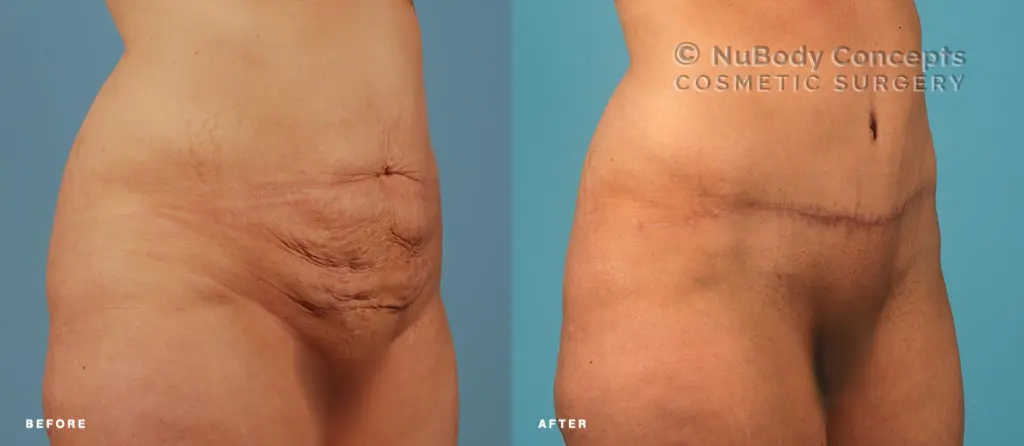I Smoked and Had a Tummy Tuck: The Impact of Smoking on Tummy Tuck Surgery - Should I stop smoking before tummy tuck i smoked and had a tummy tuck - Should I stop smoking before tummy tuck