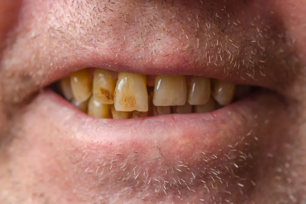 i smoked after laser teeth whitening - Will my teeth get whiter after quitting smoking